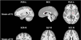 Study: Youth football changes nerve fibers in brain — (Details)