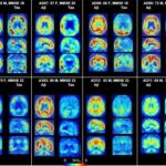 Study: Promising diagnostic tool for Alzheimer’s disease — (Details)