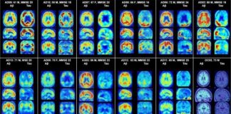 Study: Promising diagnostic tool for Alzheimer’s disease — (Details)