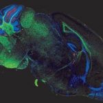 Study: New understanding of molecular underpinnings points to need for more aggressive treatment and earlier — (Details)