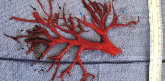 Man coughs up massive blood clot shaped like bronchial tree (Video) Man coughs up massive blood clot shaped like bronchial tree (Video)