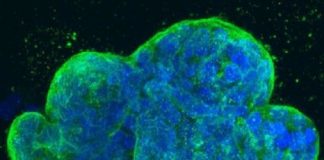 Study: An errant editing enzyme promotes tumor suppressor loss and leukemia propagation — (Details)