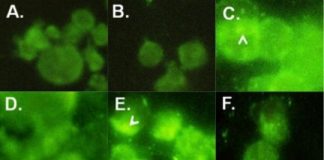 Study: New biomarker for colorectal cancers Identified — (Details)