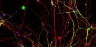Study: Neurons from people with autism exhibit different patterns of growth and develop at a faster rate — (Details)