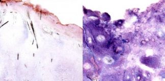 Study: Tumors not as addicted to glucose as previously thought — (Details)