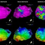 Study: How much is too much? Even moderate alcohol consumption is a risk factor for atrial fibrillation — (Details)