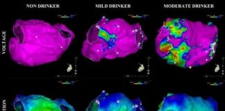 Study: How much is too much? Even moderate alcohol consumption is a risk factor for atrial fibrillation — (Details)