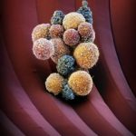 Study: Drug fights formation of metastasis — (Details)