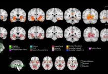 Offbeat: Teen brain volume changes with small amount of cannabis use, study finds —