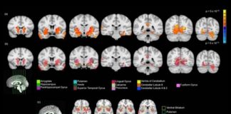 Offbeat: Teen brain volume changes with small amount of cannabis use, study finds —