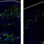 Study: Stroke drug may also prevent Alzheimer’s disease — (Details)