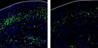 Study: Stroke drug may also prevent Alzheimer’s disease — (Details)