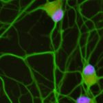 Study: Discovery opens doors to improving diagnostics and developing new therapy for majority of ALS patients — (Details)