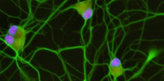 Study: Discovery opens doors to improving diagnostics and developing new therapy for majority of ALS patients — (Details)