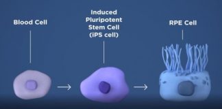 Research: Findings set stage for first clinical trial of stem cell-based therapeutic approach for AMD —