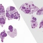 Study: Antibiotics or anti-inflammatory drugs may help combat lung cancer — (Details)