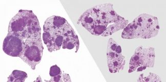 Study: Antibiotics or anti-inflammatory drugs may help combat lung cancer — (Details)