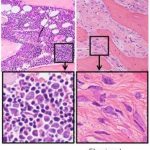 Study: Vitamin D and immune cells stimulate bone marrow disease — (Details)