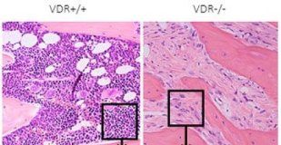 Study: Vitamin D and immune cells stimulate bone marrow disease — (Details)