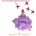 Study: Updated, safer versions of diphtheria fusion toxin DAB-IL-2 show promise in reducing tumor growth — (Details)