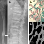 Study: New form of hereditary osteoporosis — (Details)