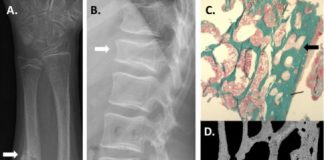 Study: New form of hereditary osteoporosis — (Details)