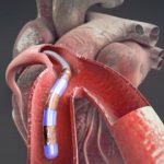 Study: Overcoming cardiovascular disease with a magnetically-steerable guidewire microrobot — (Details)