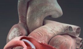 Study: Overcoming cardiovascular disease with a magnetically-steerable guidewire microrobot — (Details)