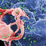 Study: HIV remission achieved in second patient — (Details)