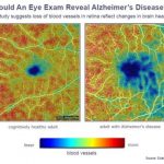 Study: Could an eye doctor diagnose Alzheimer’s before you have symptoms? (Details)