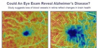 Study: Could an eye doctor diagnose Alzheimer’s before you have symptoms? (Details)