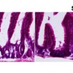 Study: Rsearchers explore stroke’s effects on microbiome — (Details)