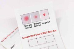 Study: Simple urine test allows for rapid diagnosis of preeclampsia — (Details)