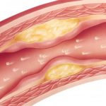 Study: Taking statins for heart disease cuts risk in half, yet only 6 percent of patients taking as directed — (Details)