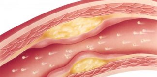 Study: Taking statins for heart disease cuts risk in half, yet only 6 percent of patients taking as directed — (Details)