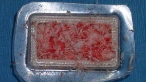 Study: 3D implants made inside the patient — (Details)