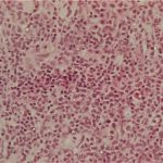 Study: Epigenetic protein could be new therapeutic target in acute myeloid leukemia — (Details)