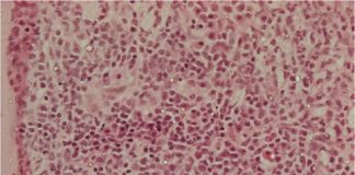 Study: Epigenetic protein could be new therapeutic target in acute myeloid leukemia — (Details)