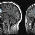 Study: Measuring differences in brain chemicals in people with mild memory problems — (Details)
