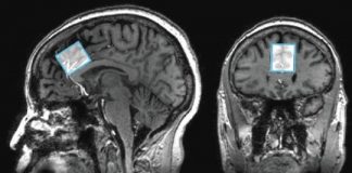 Study: Measuring differences in brain chemicals in people with mild memory problems — (Details)