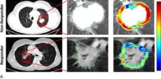 Study: Radiomics predicts who will benefit from chemotherapy — (Details)