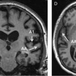 Study: Study of rare dementia shows selective attack on areas of brain — (Details)