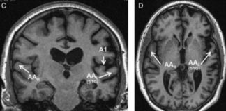 Study: Study of rare dementia shows selective attack on areas of brain — (Details)