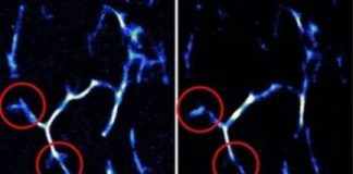 Study: Technique uses well-known dye to watch amyloid plaques in the brain — (Details)