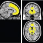 Study: Novel brain map tracks early brain atrophy from HIV infection — (Details)