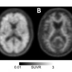 Study: First phase of nationwide study demonstrates clinical impact of amyloid PET imaging — (Details)