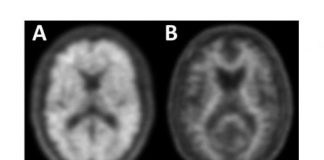 Study: First phase of nationwide study demonstrates clinical impact of amyloid PET imaging — (Details)