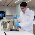 Study: Lung disease bronchiectasis associated with high frequency of allergy — (Details)