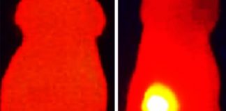 Study: Melanin as a new diagnosis and treatment tool for tumors — (Details)