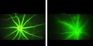 Study: Experiments show new therapy slows blood vessel leakage associated with diabetic macular edema and macular degeneration — (Details)